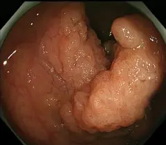 内視鏡画像 書写西村内科