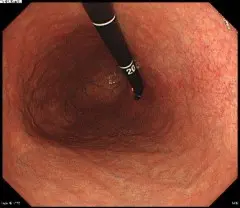 内視鏡画像 | 書写西村内科