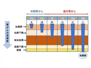 早期胃がんについて 書写西村内科