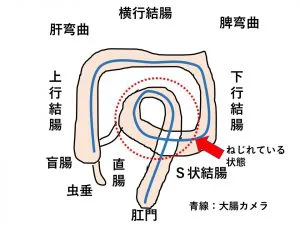 s ストア 字 結腸 カメラ