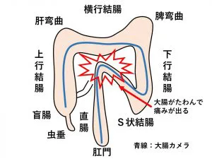 s ストア 字 結腸 カメラ